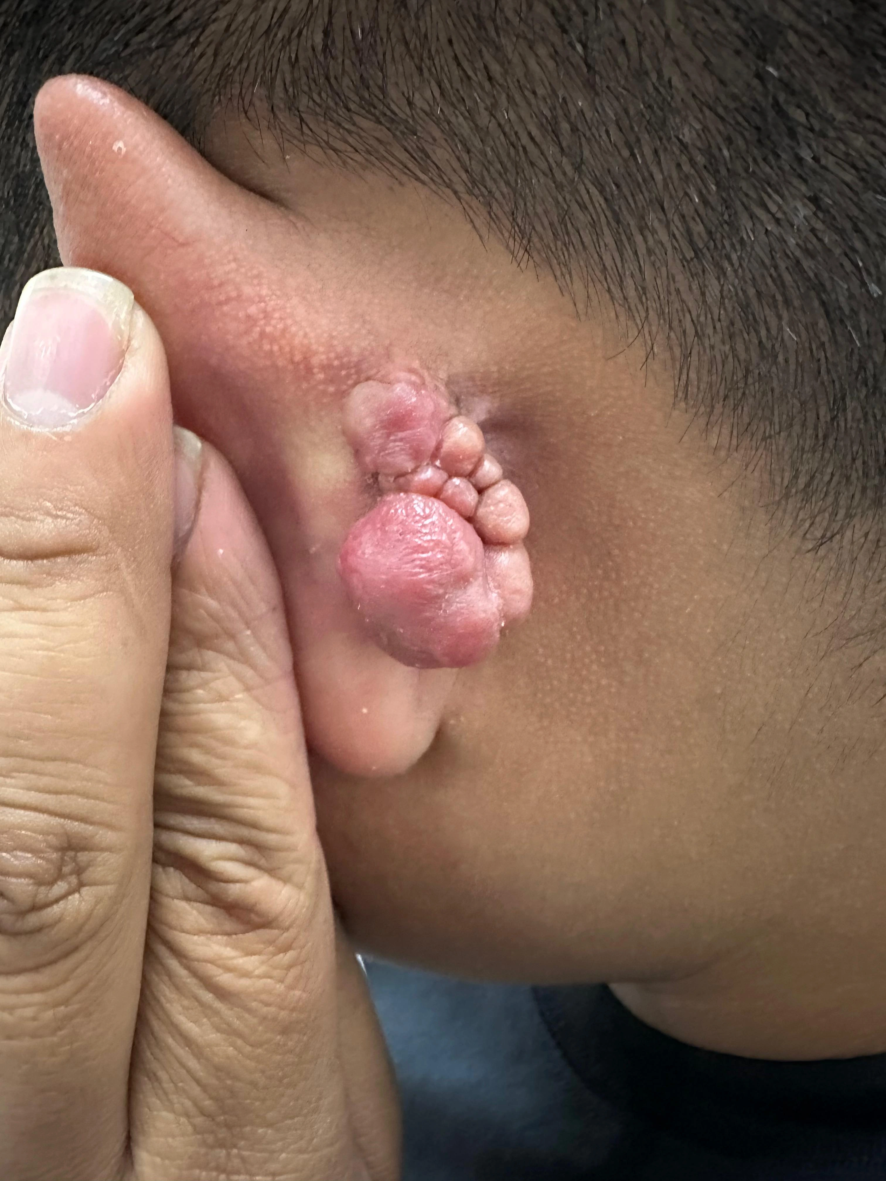 Tratamiento de Queloides - Antes